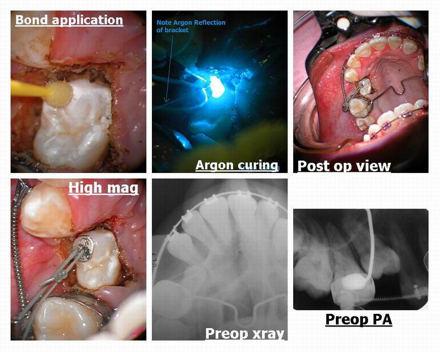 Resize of Exposure of premolar pg3.jpg